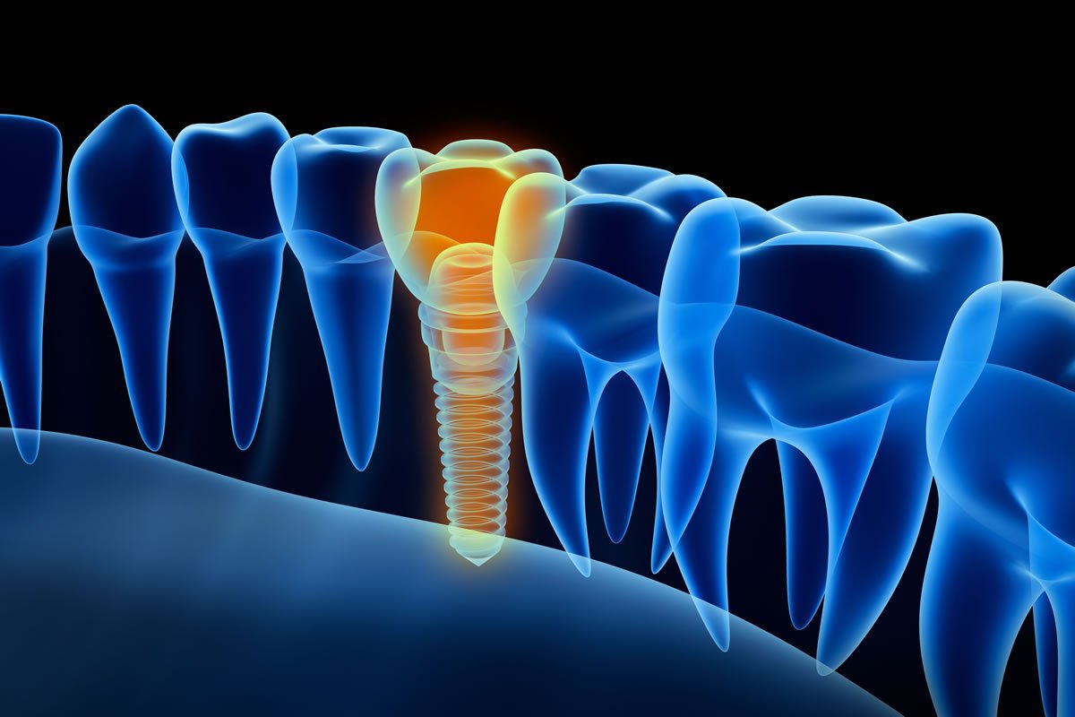ایمپلنت‌ فوری دندان چیست؟