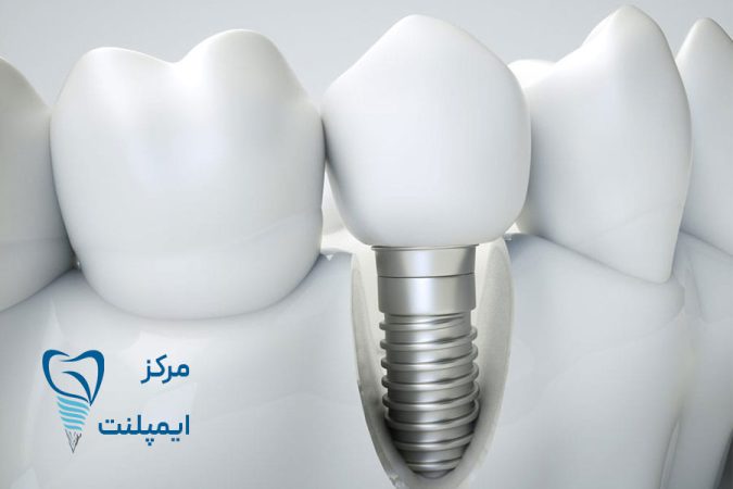 تفاوت ایمپلنت آمریکایی با کره ای