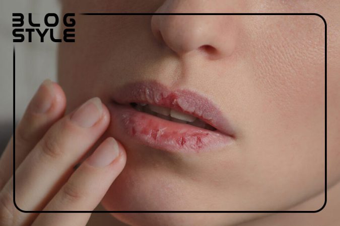 چگونه خشکی لب را از بین ببریم