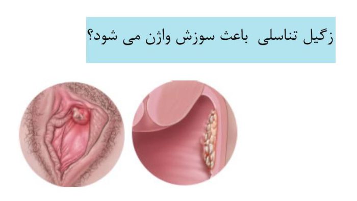 عکس زگیل تناسلی واژن