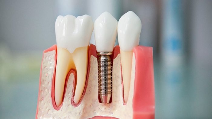 قیمت ایمپلنت سوئیسی