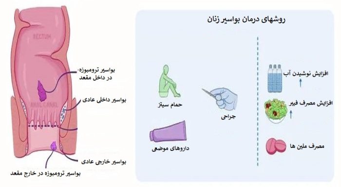 انواع روشهای درمان بواسیر زنان